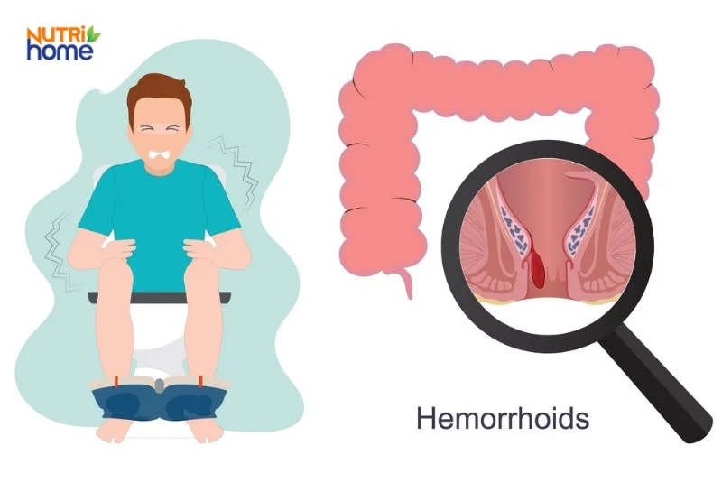 Trĩ nội độ 1: Biểu hiện, hình ảnh và chữa như thế nào? (2)