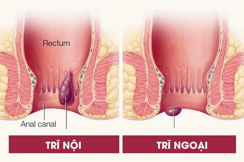 Trĩ nội, trĩ ngoại là gì, cách thức chẩn đoán và điều trị